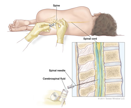 Lumbar Puncture Spinal Tap